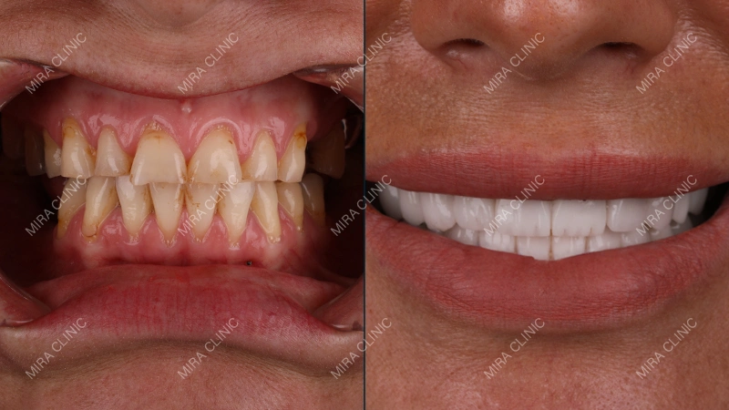 Before and After Hollywood Smile